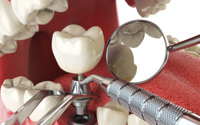 Darwenside Dental Presents: Dental Implants