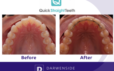 Darwenside Dental Presents: Quick Straight Teeth