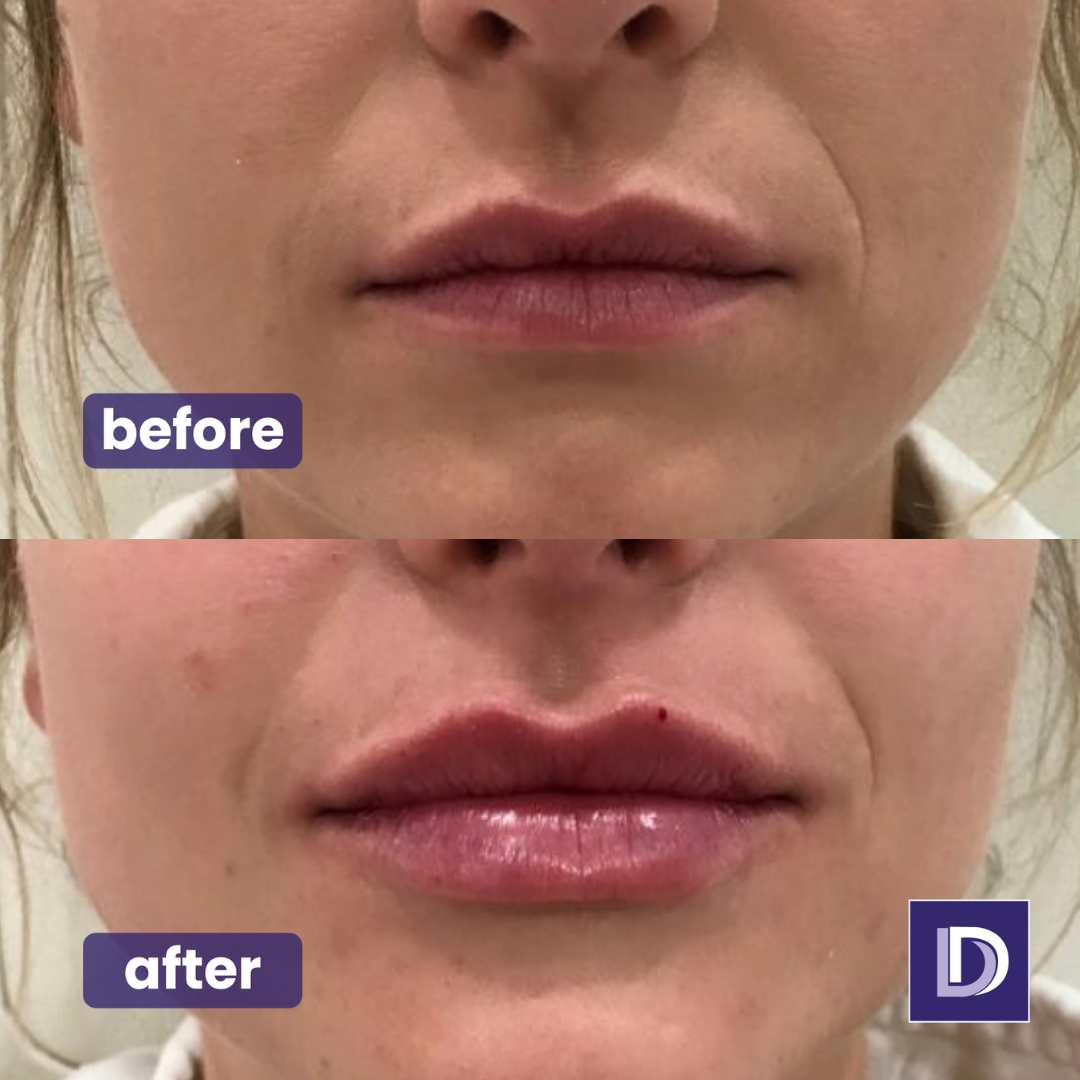 Dermal Lip Filler Treatment Facial Aesthetics Darwen Blackburn Bolton